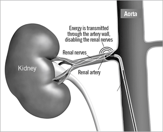 Renal Denervation {faces}